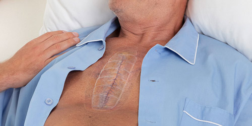 Un homme se penche en arrière sur son oreiller. Son pyjama est ouvert, laissant voir sur sa poitrine une longue cicatrice sous un bandage transparent. Un homme se penche en arrière sur son oreiller. Son pyjama est ouvert, laissant voir sur sa poitrine une longue cicatrice sous un bandage transparent.